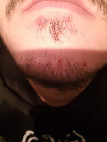 Ist das Herpes an meinem Kinn?