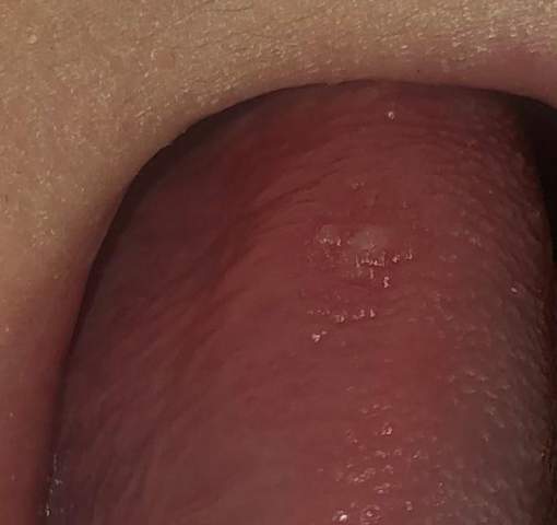 Ist das Krebs an meiner Zunge?