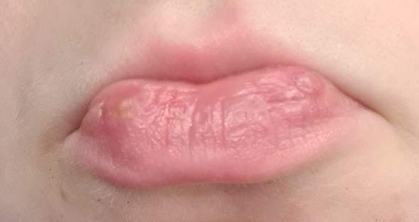 Ist das Lippen Herpes?