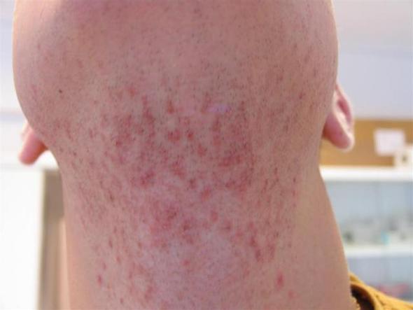 So sieht es aus (Foto aus den Internet)  - (Haut, Pickel, Dermatologie)