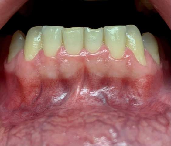 Ist das Zahnfleisch entzündet?