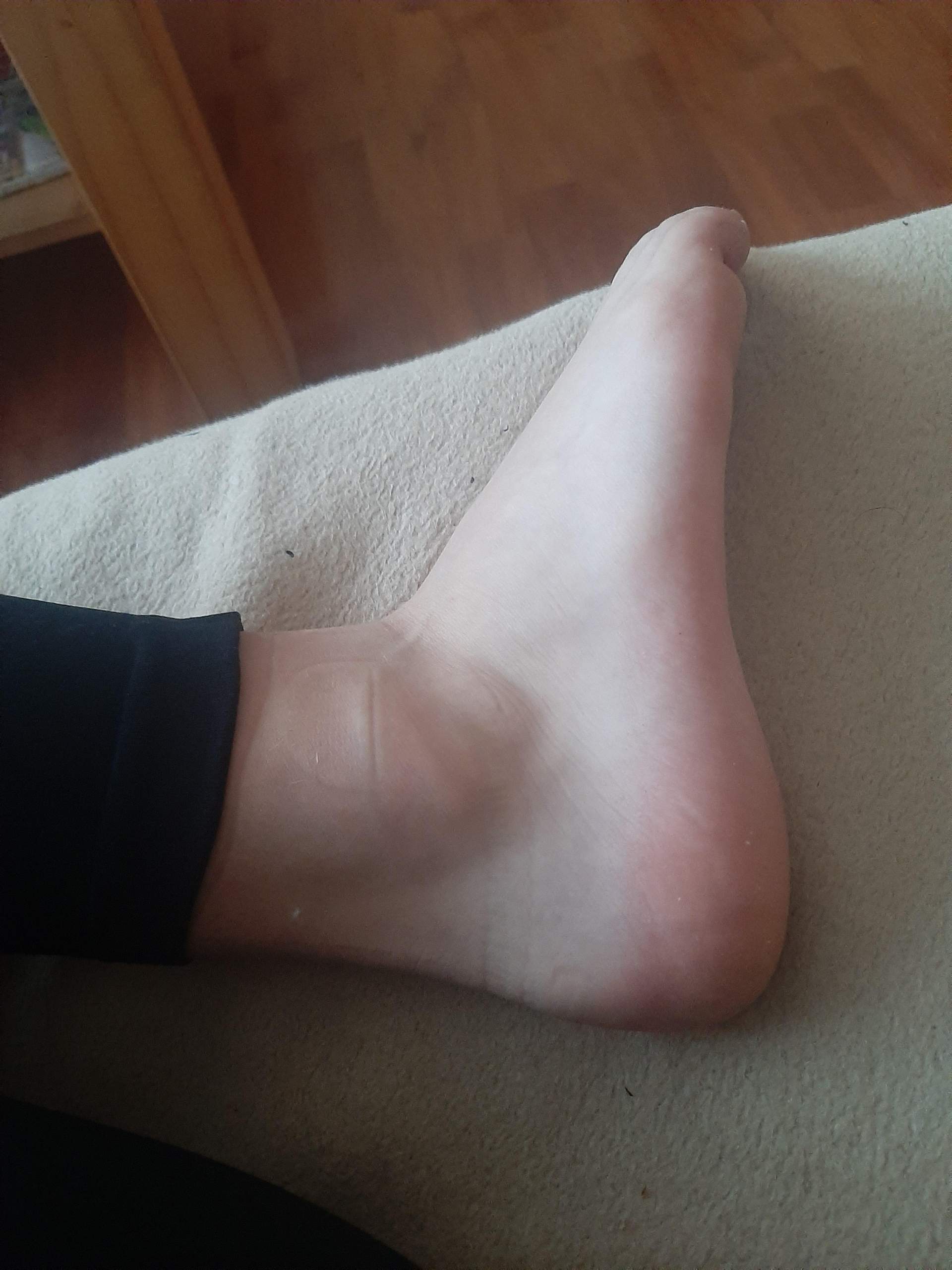 Fuß verstaucht geschwollen