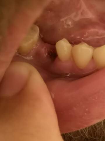 Zahn gezogen essensreste in wunde