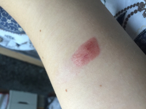 Ist Die Wunde Nicht Richtig Verheilt Infektion Heilung Narben Ist Die Wunde Nicht Richtig Verheilt Infektion Heilung Narben