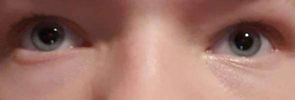 Ist diese Pupillengröße bei Licht normal?