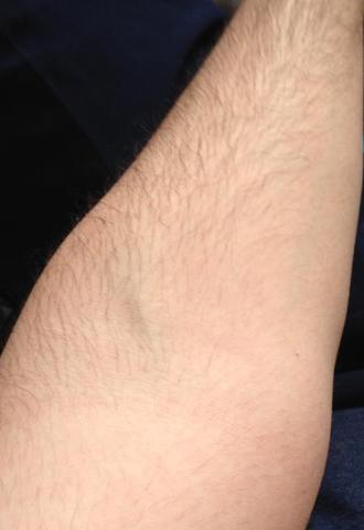 Ist diese schwarze Ader auf meinem Arm normal wenn ich Hanteltraining