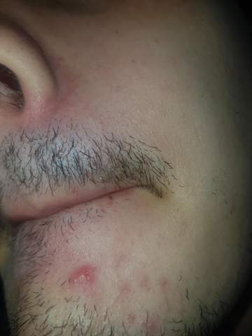 - (Haut, Herpes)