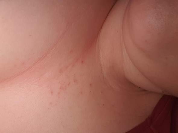 - (Allergie, Krankheit, Juckreiz)