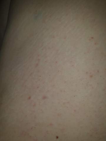 - (Allergie, Krankheit, Juckreiz)