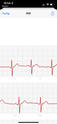 Ist mein EKG nicht normal?