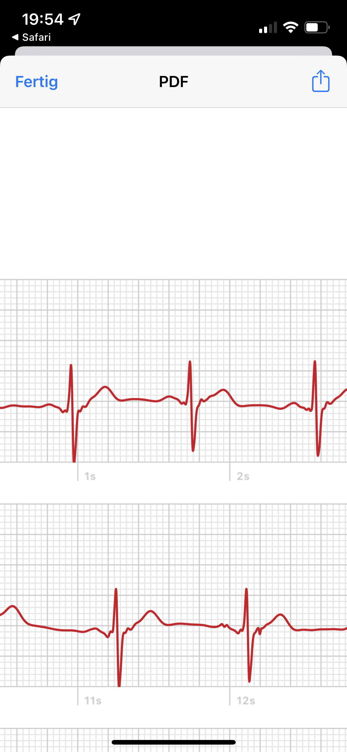 Ist mein EKG nicht normal? (Gesundheit, Herz)