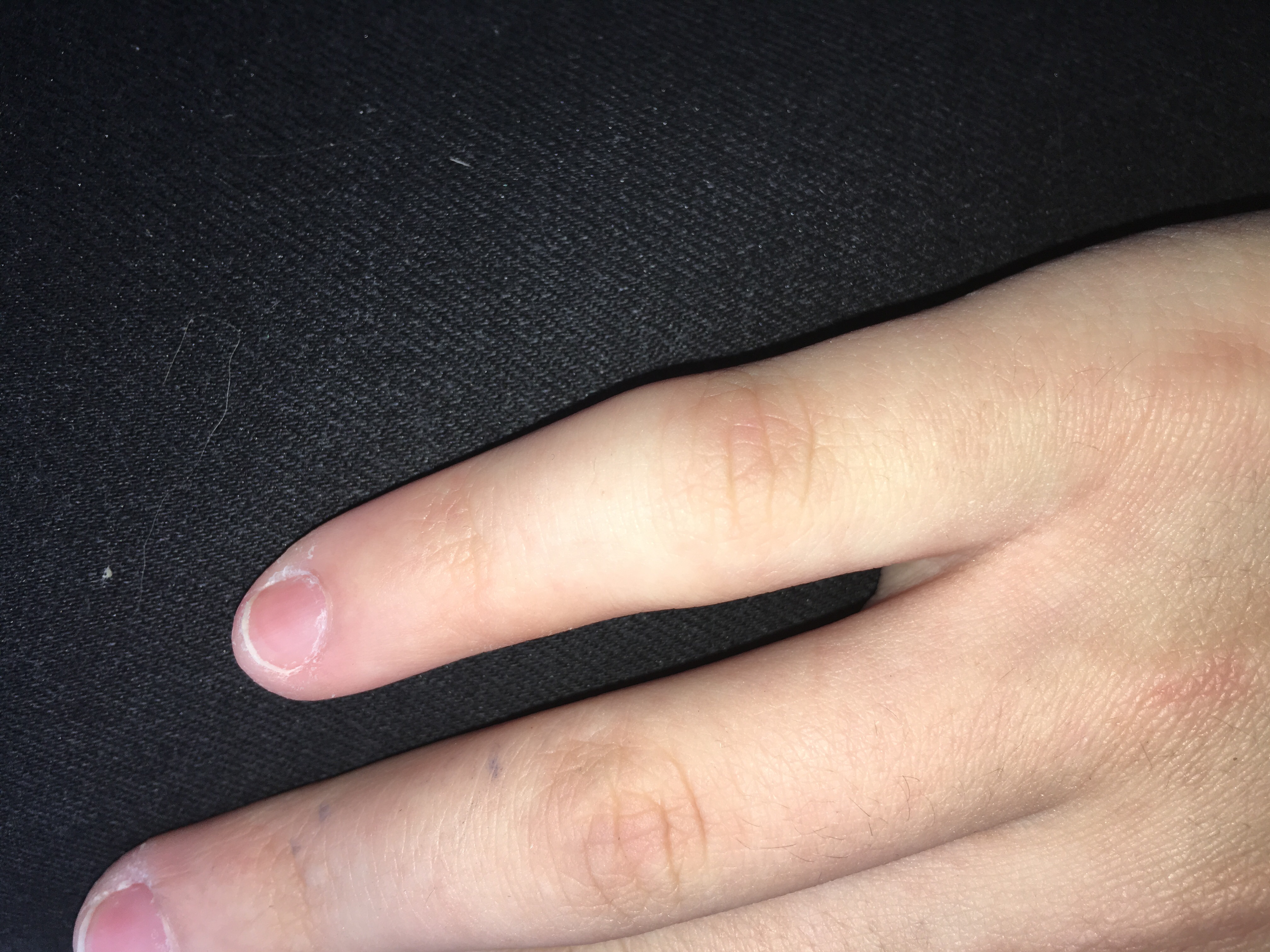 Ist mein Finger gebrochen,verraucht oder ist die Kapsel