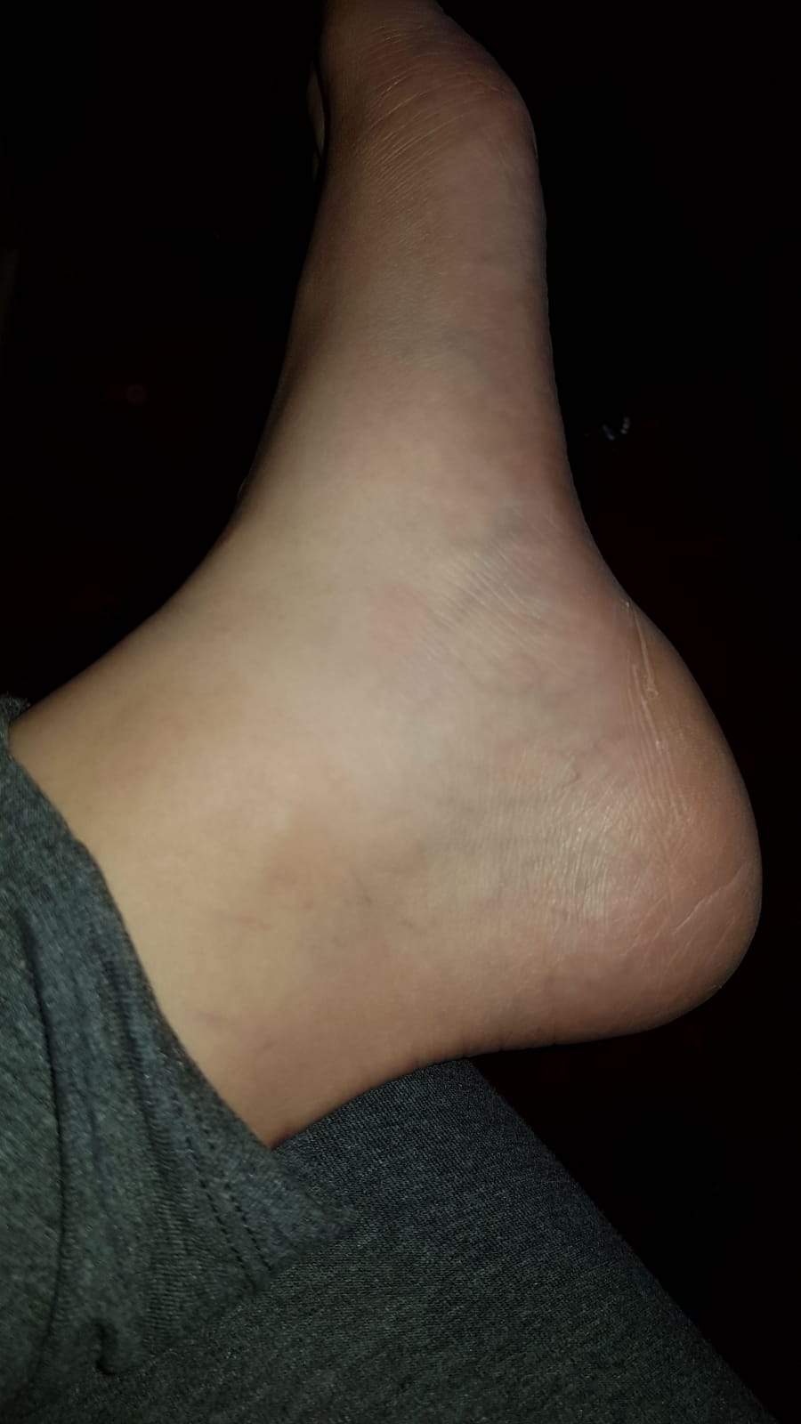 Ist mein Fuß gezerrt oder ist etwas gerissen? (Schmerzen, knöchel)