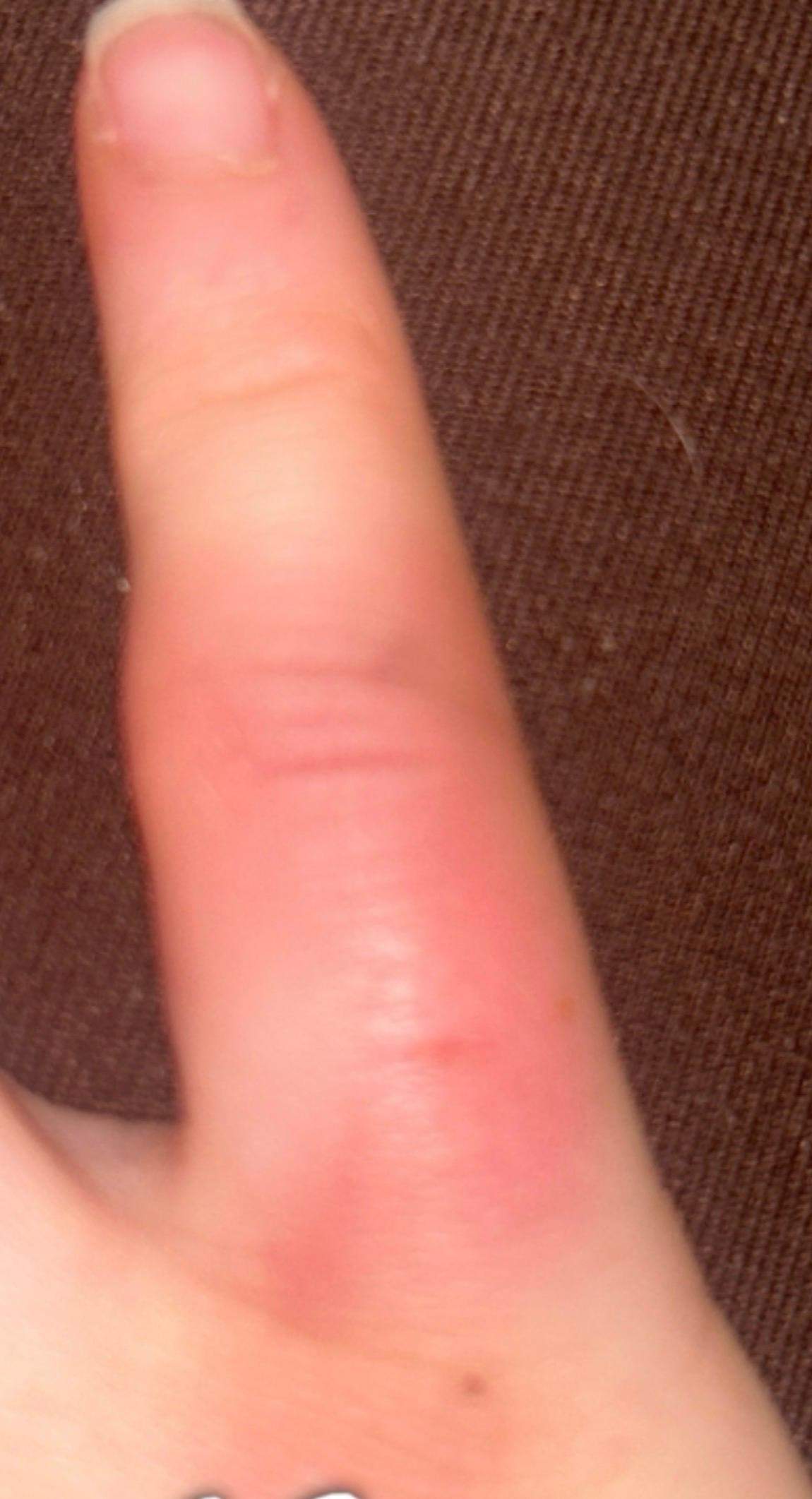 Ist mein kleiner Finger gebrochen? (Schmerzen, Gesundheit und Medizin ...