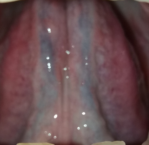 Ist meine Zunge geschwollen und wenn ja, woran kann man das erkennen?