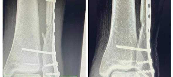 Ist schon ein Fortschritt zu sehen Röntgenbild?