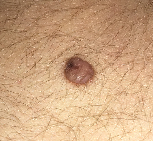 ggg - (Haut, Dermatologie, Muttermal)