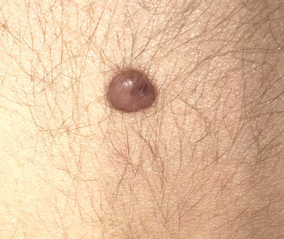 hh - (Haut, Dermatologie, Muttermal)