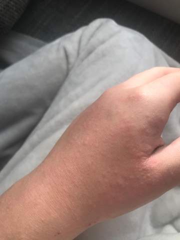 Juckende Pickel An Der Hand Haut Juckende Pickel An Der Hand Haut