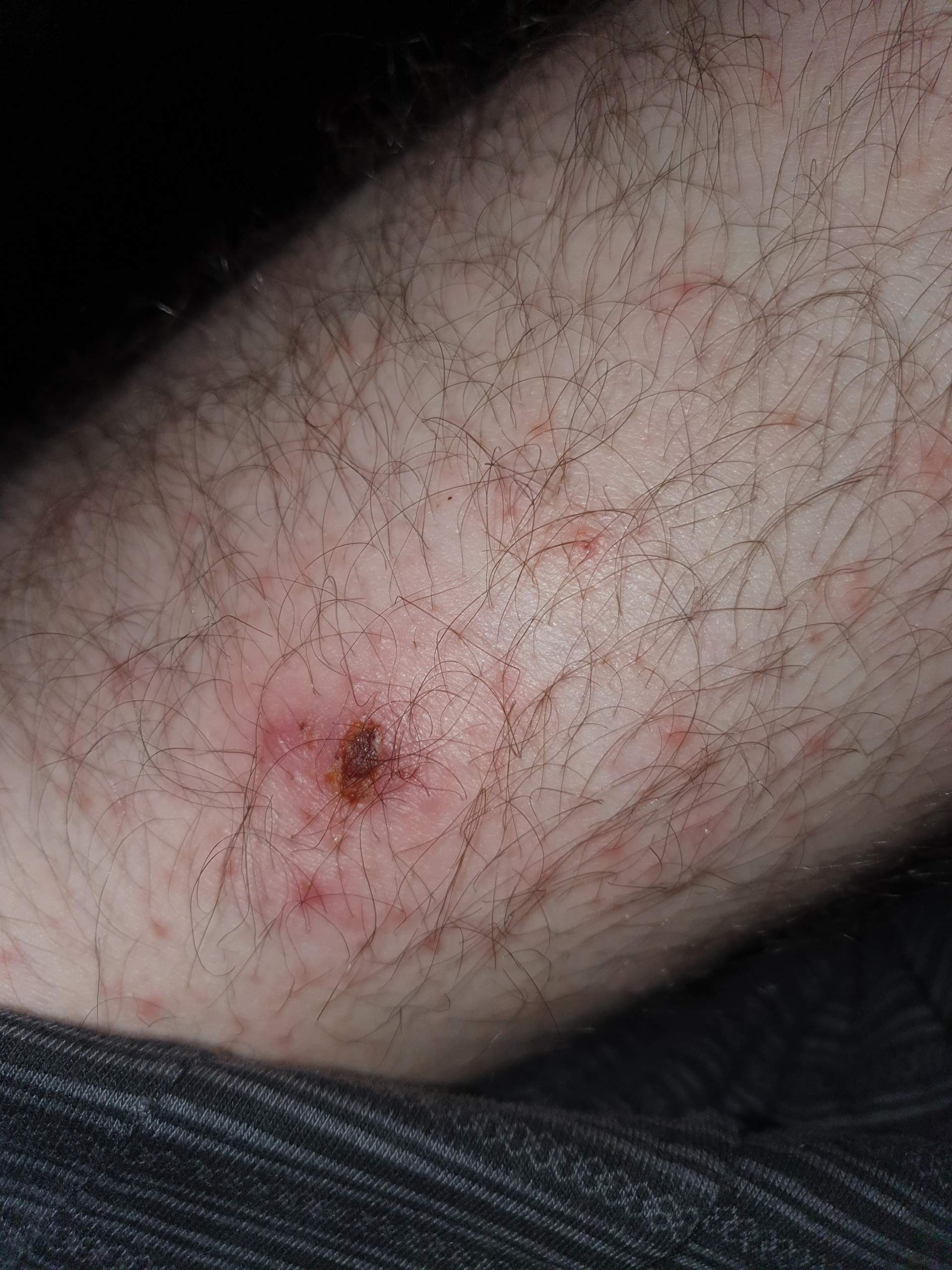 Juckende Stellen am Körper? (Haut, Juckreiz)