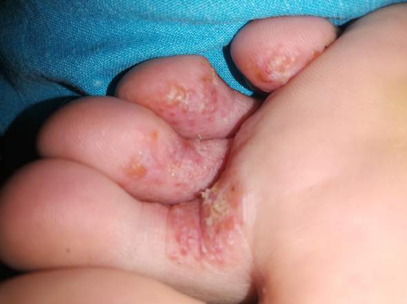 Juckende und schmerzende rote Stellen, ist das Fußpilz oder etwas anderes?