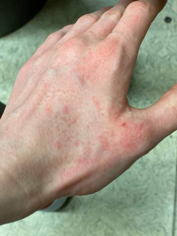 Juckender Ausschlag Am Korper Beine Juckreiz Bauch Juckender Ausschlag Am Korper Beine Juckreiz Bauch