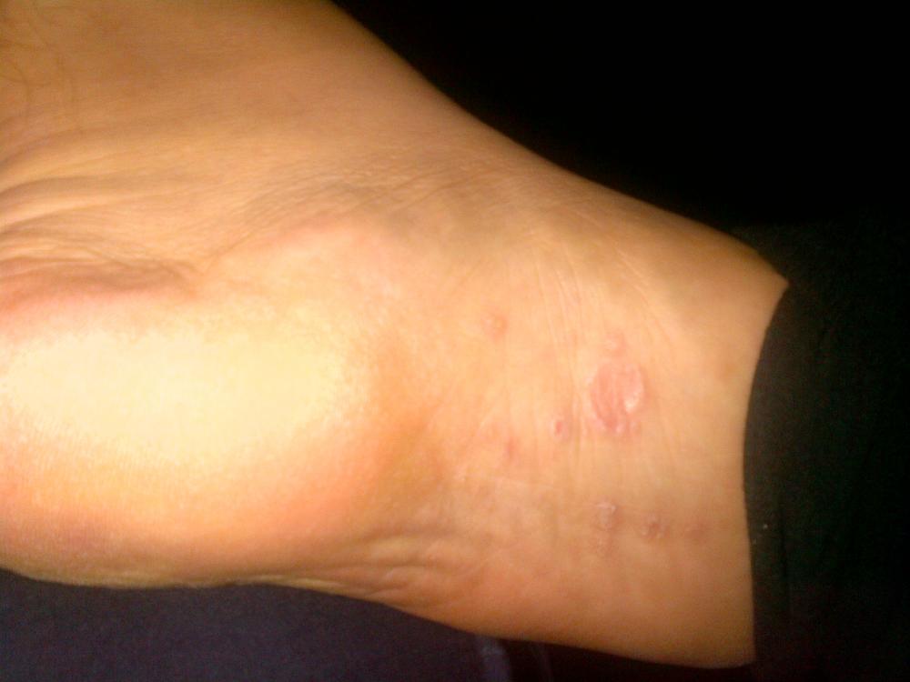 Juckender Ausschlag (Füße, Hand, Dermatologie)