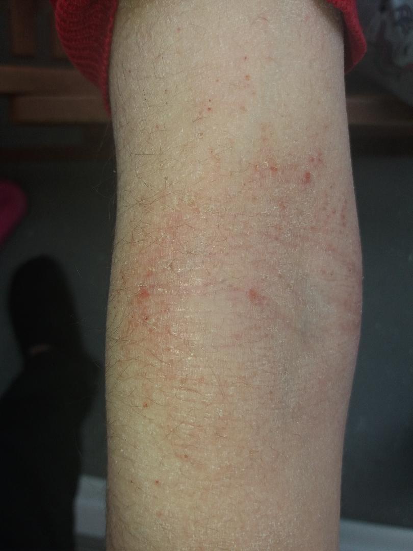 Juckender Hautausschlag ,Allergischer Hautausschlag? (Haut, Allergie)