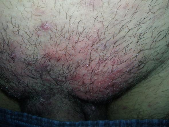 beharrung über penis - (Juckreiz, Ausschlag, Pilze)