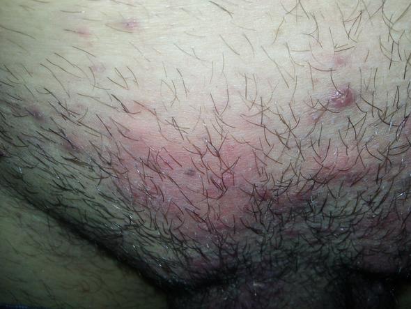 beharung über penis2 - (Juckreiz, Ausschlag, Pilze)