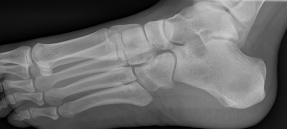 Fuß röntgen - (Füße, Bruch, Chirurgie)