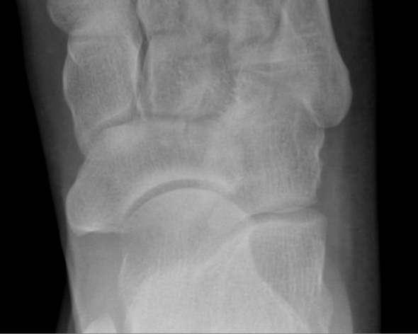 Fuß röntgen 2 - (Füße, Bruch, Chirurgie)