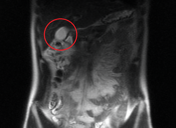 Kann man mir bei dem MRT Bild helfen? (Flecken)