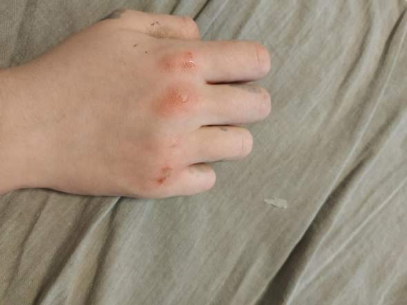 Kann meine Hand von gegen die Wand schlagen schlimmern schaden tragen?