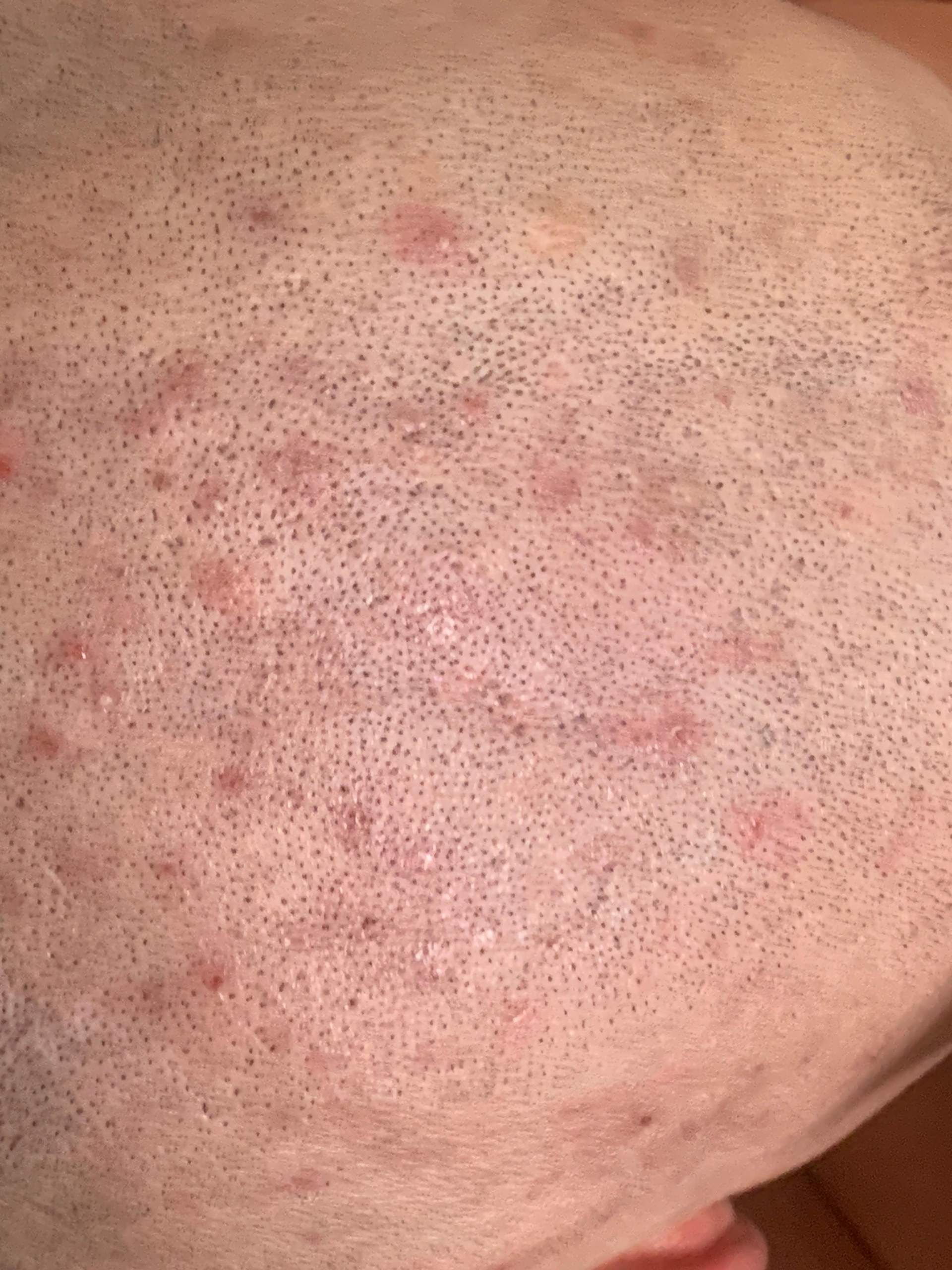 Kann mir bitte jemand sagen was da gegen machen kann? Pickel am kopf? (Haut) pickel kopf