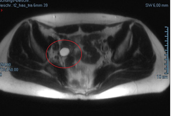 Bild 2 - (Darm, Bauch, MRT)