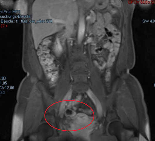 Bild 3 - (Darm, Bauch, MRT)