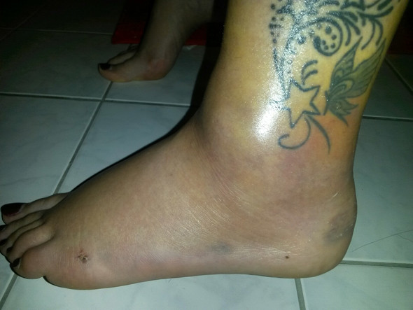 Kapsel Und Banderriss Vor Zwei Wochen Warum Habe Ich Immer Noch Probleme Schmerzen Fusse Korper Kapsel Und Banderriss Vor Zwei Wochen Warum Habe Ich Immer Noch Probleme Schmerzen Fusse Korper