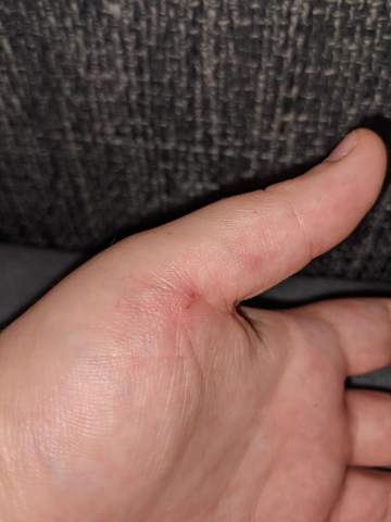 Katzenbiss Immer Arzt Notwendig Katzenbiss Immer Arzt Notwendig