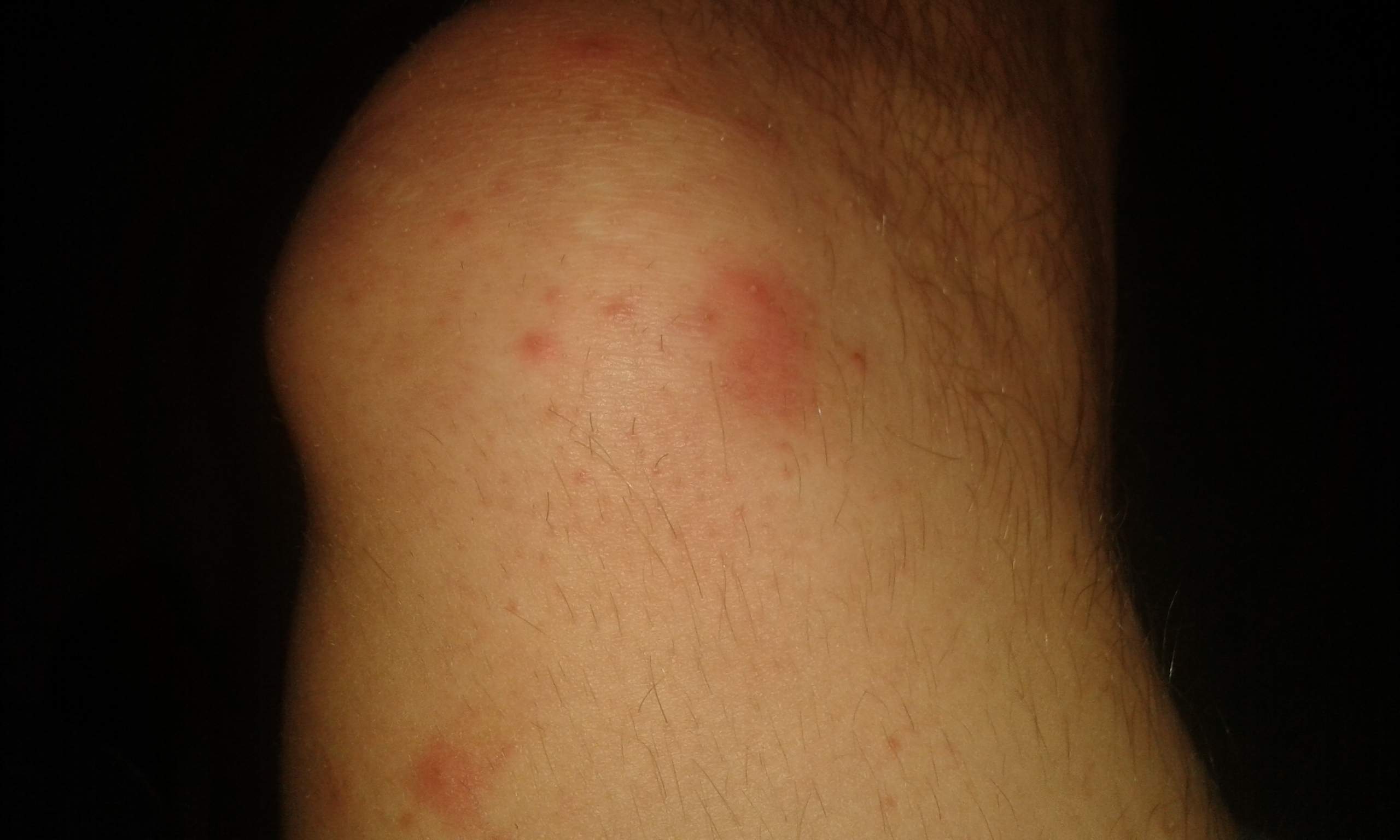 Kleine Eitrige Pickel Oberschenkel Arm und bauch (Hautprobleme, Eiter)