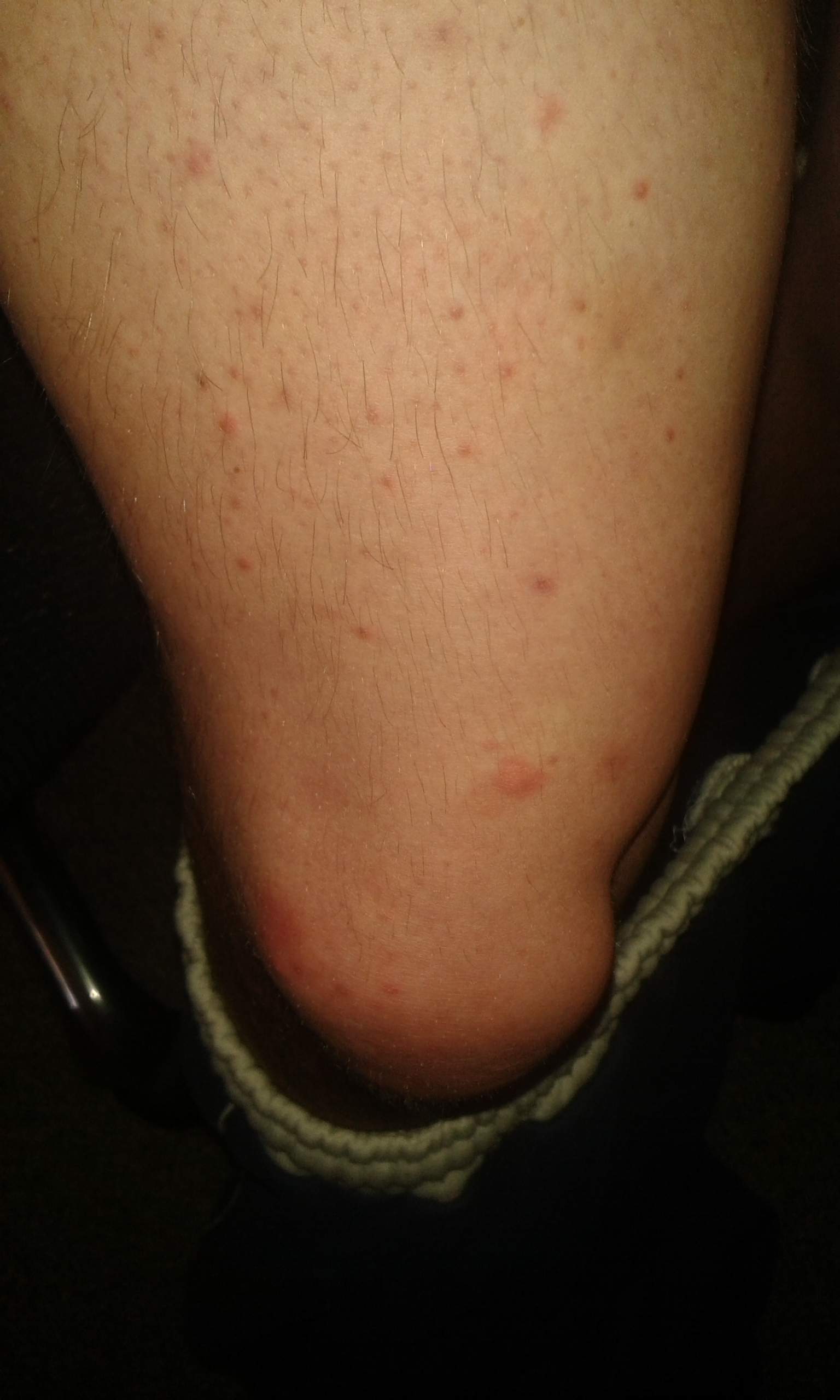 pickel mit eiter pickel mit eiter