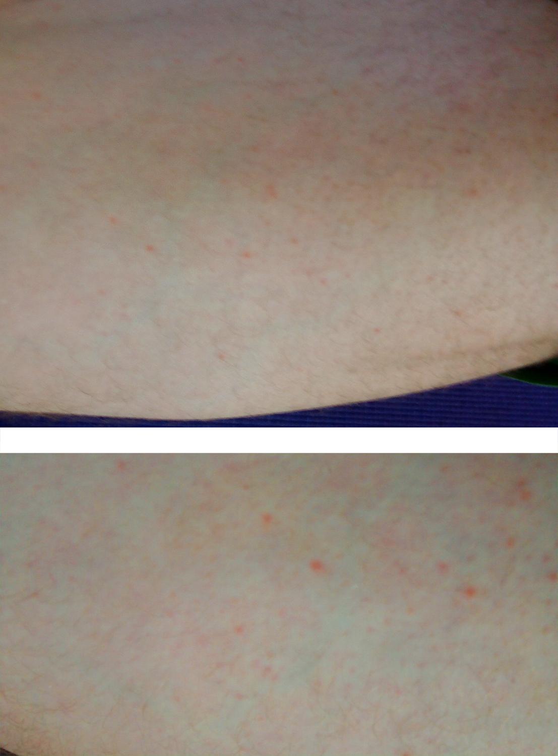 Kleine Pickel auf den Oberschenkeln - Woher kommen sie? (Haut, Beine, Symptome) pickel auf dem oberschenkel