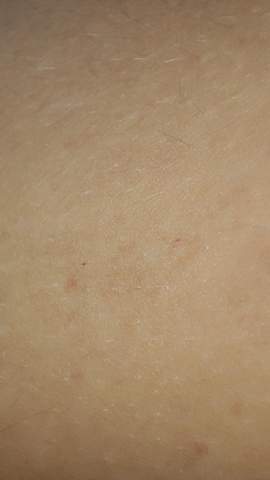 Kleine Rote Blutpunkte auf der Haut?