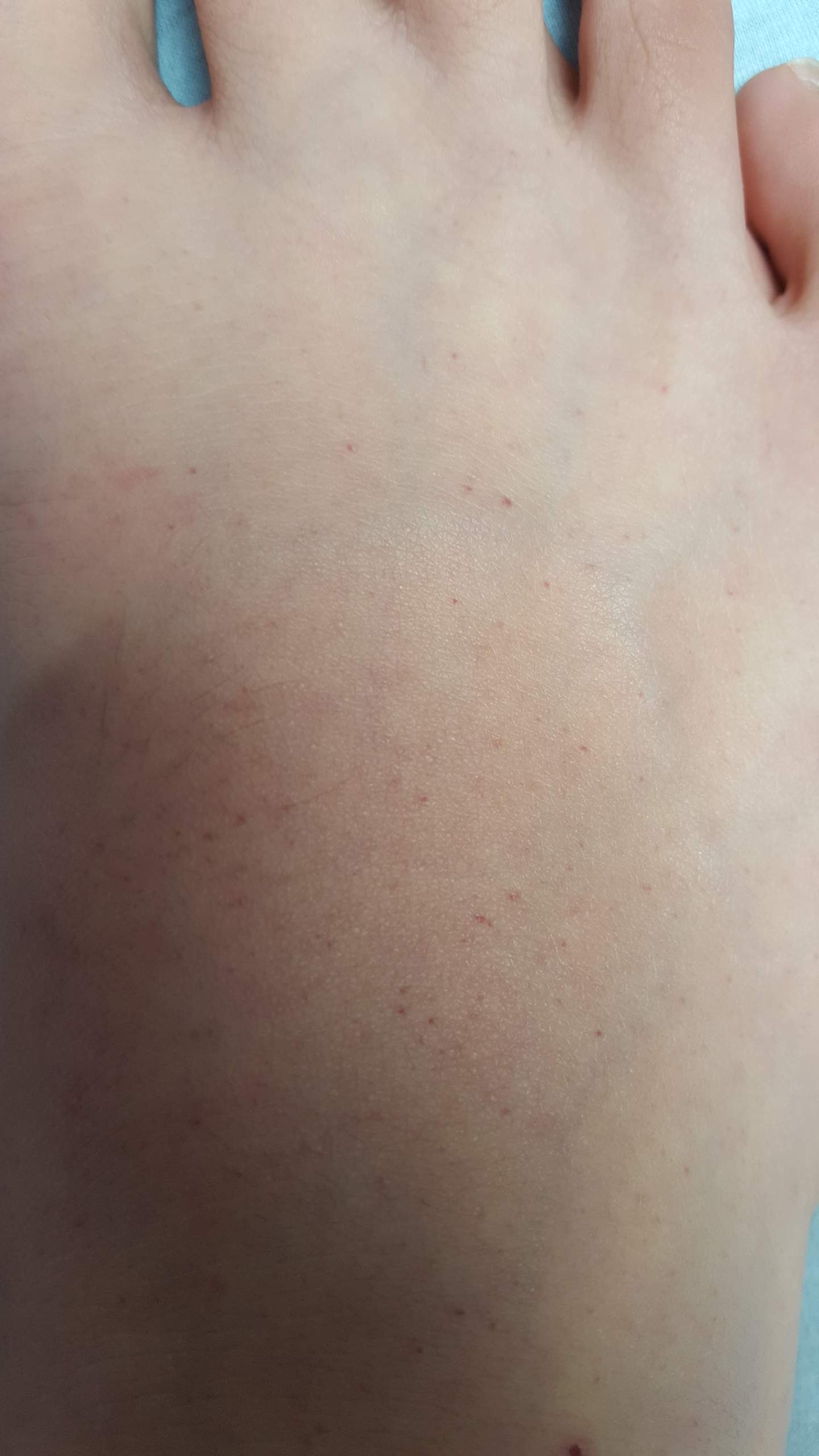 Kleine rote Punkte auf dem Fuß ? (Füße)