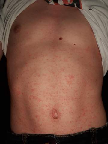 Kleine Rote Punkte Auf Der Haut Was Tun Kleine Rote Punkte Auf Der Haut Was Tun