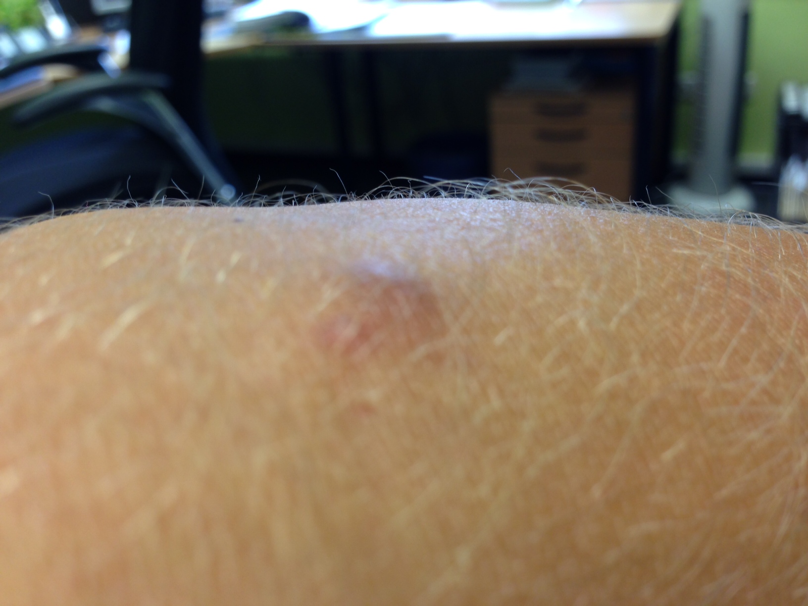 kleine Wucherung am Arm (hautarzt) kleine Wucherung am Arm (hautarzt)