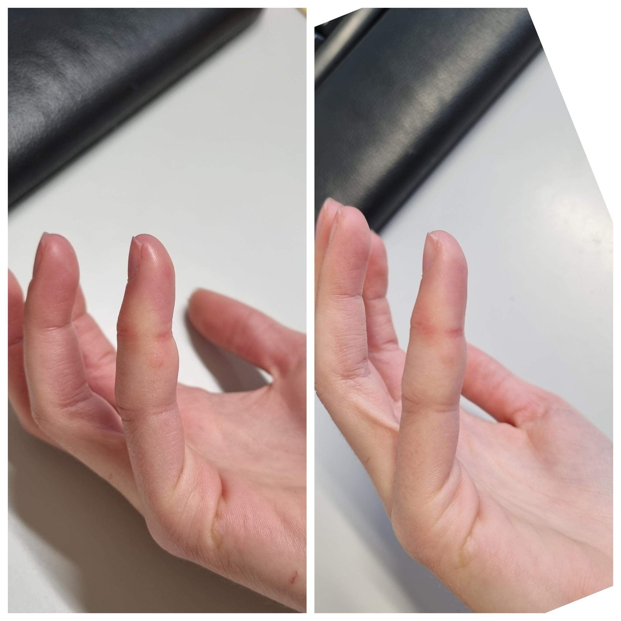 Kleiner Finger geschwollen. Warum? (Gesundheit, Schwellung)