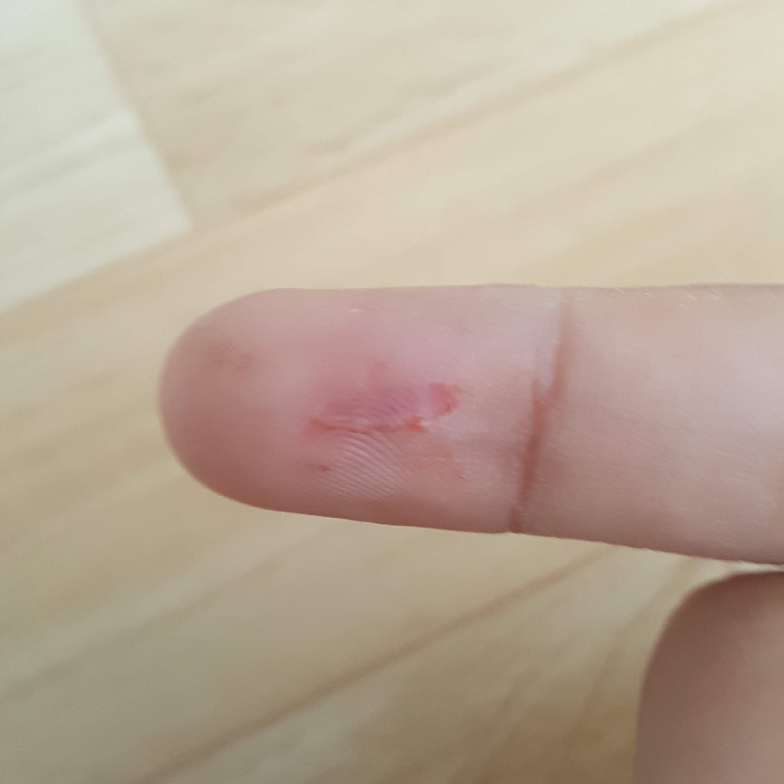 Kleiner Schnitt am Finger - Tetanus Impfung erforderlich? (Wunde ...