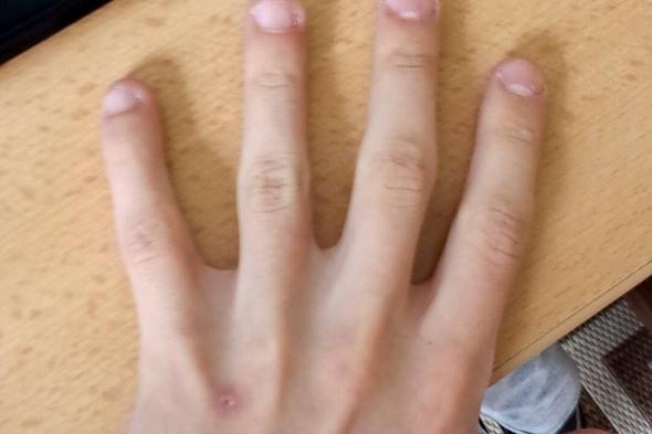 Linke Hand - ohne Verletzung - Grundbau - (Operation, Finger, Riss)