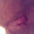 Knubbel am After was ist das ? (Haut, Pickel, Hämorrhoiden) Knubbel am After was ist das ? (Haut, Pickel, Hämorrhoiden)